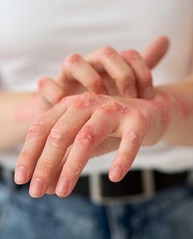 egzama-nermin egzama-nermin