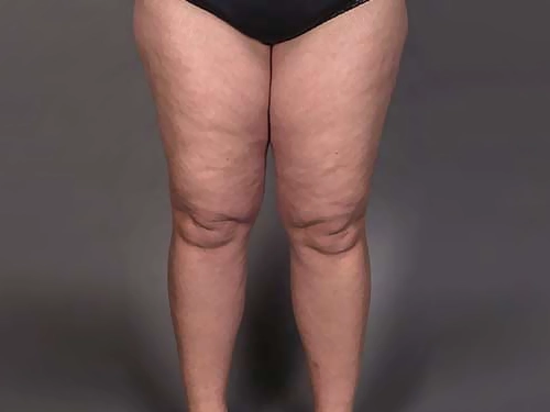lipodem-evreleri lipodem-evreleri