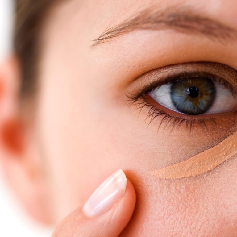 göz-altı-morluğu-tedavisi