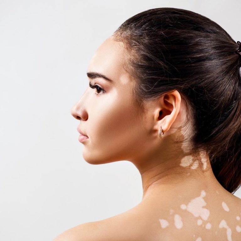 vitiligo